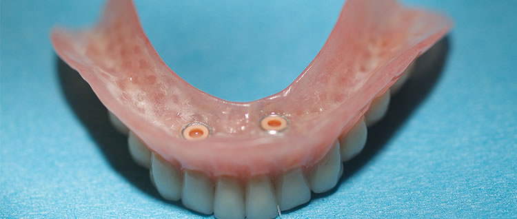 Filtre conique pour le système de dessiccation à fibres membranaires –  Dental Services