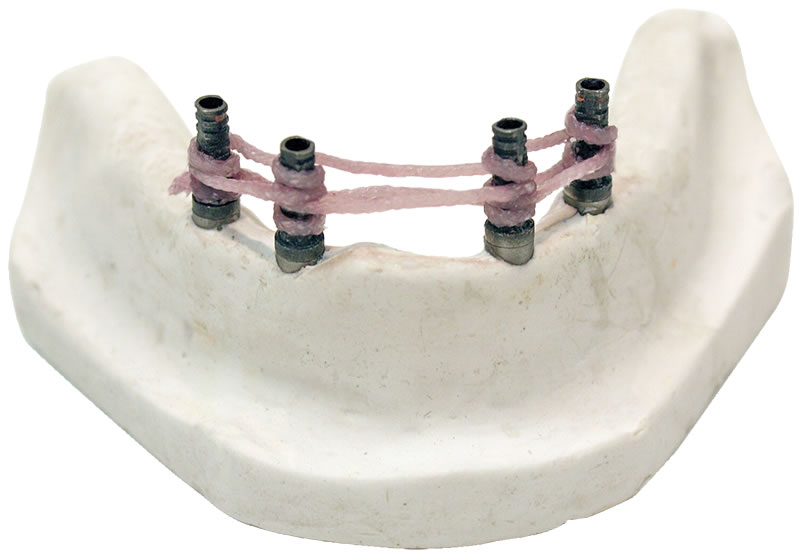 cst temp denture