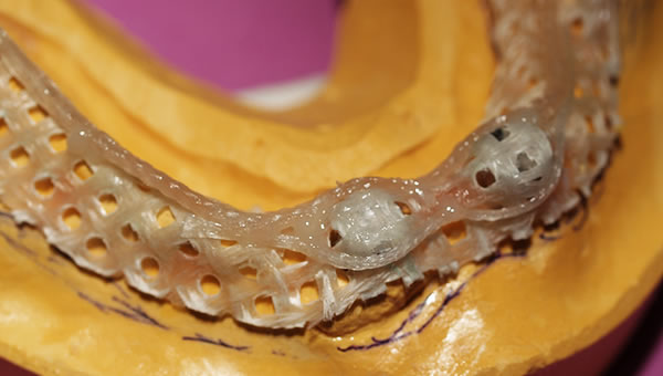fiber force implant denture