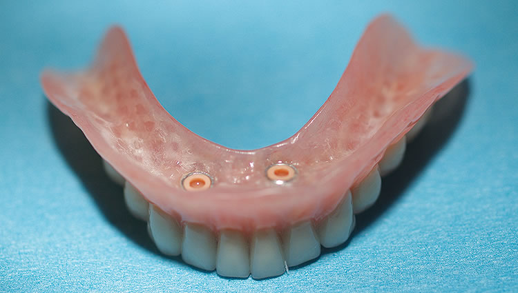 fiber force implant denture