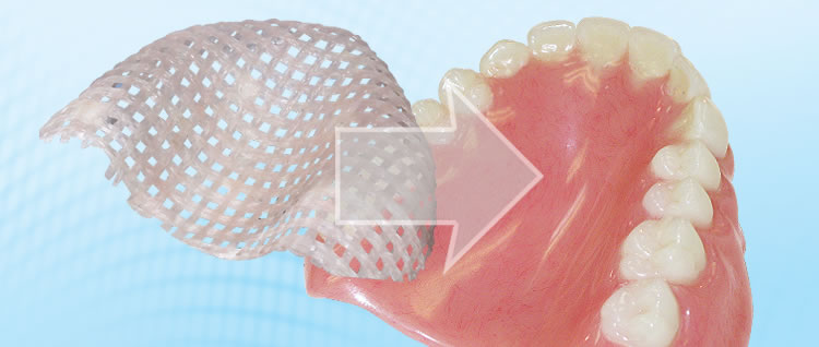 fiber force denture